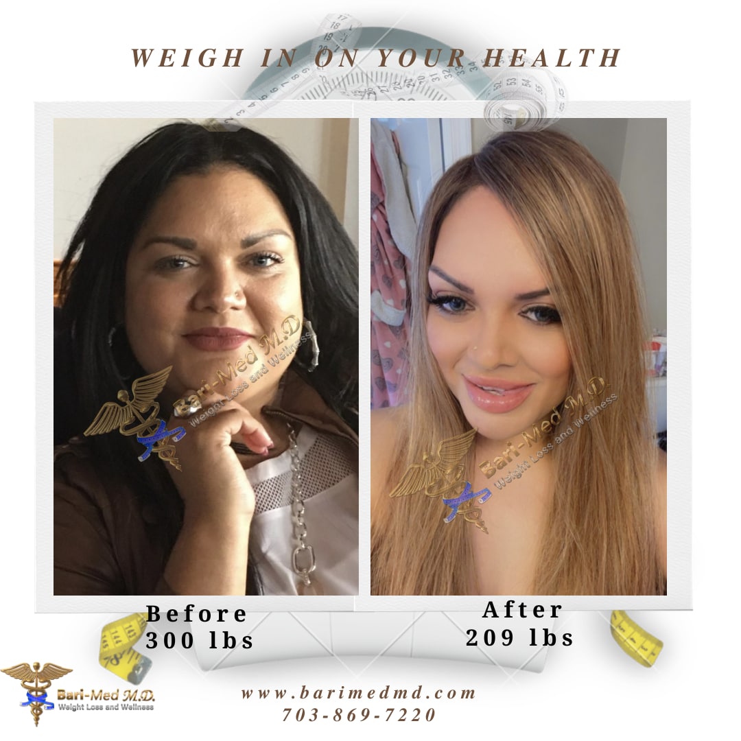 A woman before and after weight loss surgery.