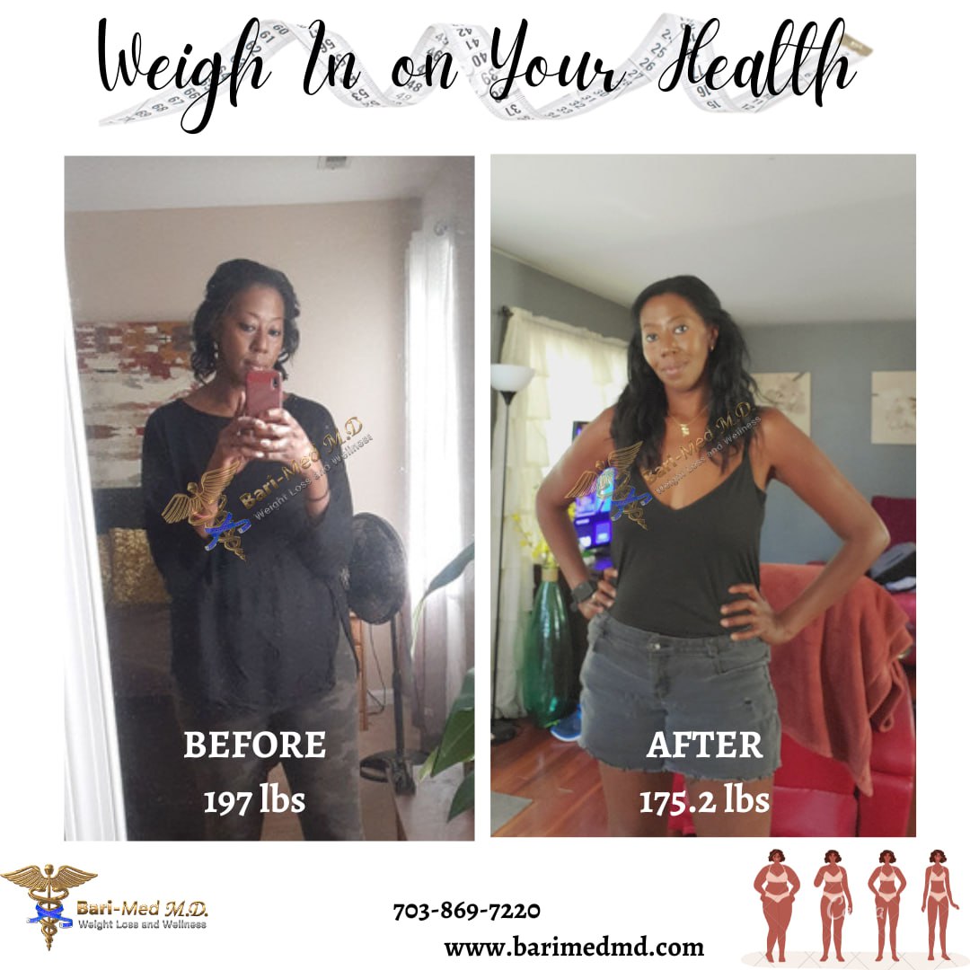 A woman is in the mirror and before and after weight loss.