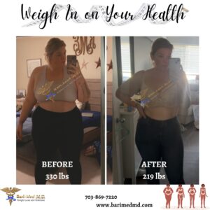 A woman is in the mirror and before and after her weight loss.